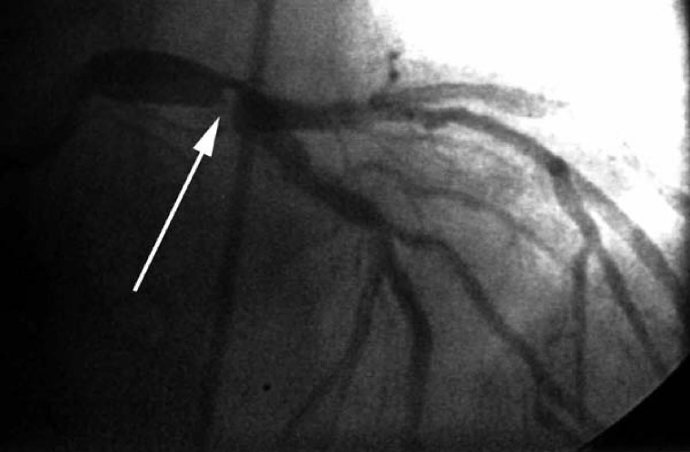 коронарография, показваща
            стволова стеноза на лявата коронарна артерия